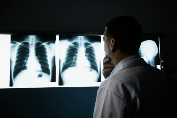 Radiologist looking at x-ray images of lungs, searching for lung cancer possibly caused by asbestos.