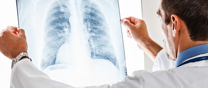 Image of a doctor examining a lung radiography. Doctor is searching for signs of lung cancer caused by asbestos.